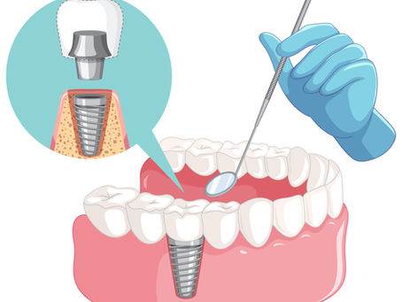Are Dental Implants Worth It? Long-Term Benefits Explained