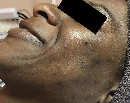 microdermabrasion-B _2.jpg