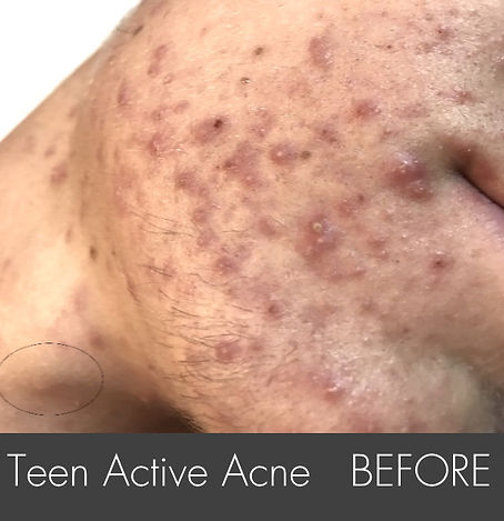 Teen Activer Acne_ Treatment-side- B1.jp