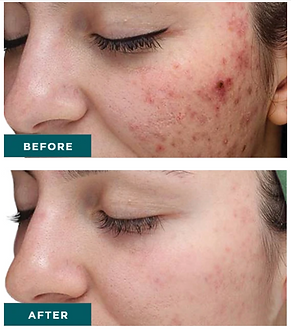 VI PEEL Purify with Precision Plus
