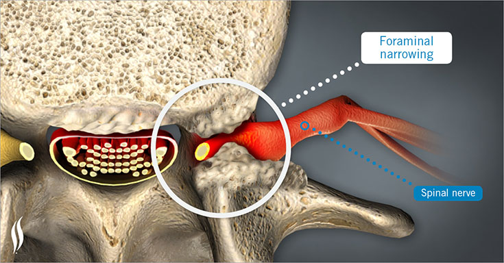 Foraminal Encroachment vs. Foraminal Stenosis