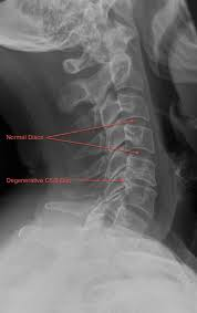 Joint Biomechanics and Degenerative Disc Disease