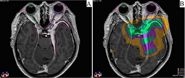 exemplo de radioterapia para meningioma
