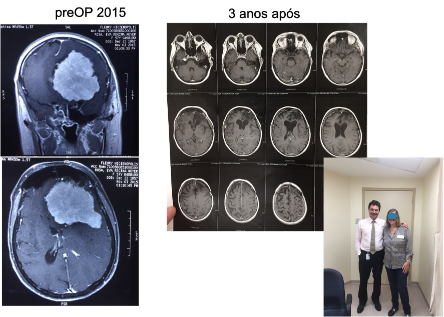 enorme meningioma na base do crânio e o resultado cirúrgico