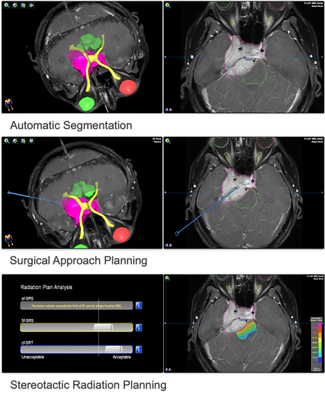 exemplo de planejamento de radiocirurgia em caso de meningioma comprimindo nervos ópticos