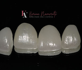 Lentes de Contato Dental em Montes Claros