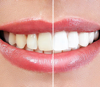 Clareamento Dental em Montes Claros