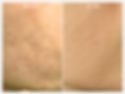 PRP Before and After Photos