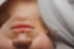 IPL Treatment