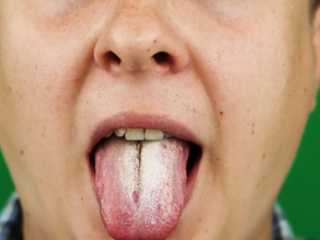 Candida, Thyroid, Diet