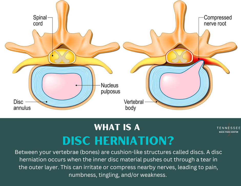 What Is a Disc Herniation? Understanding the Cause of Your Back Pain