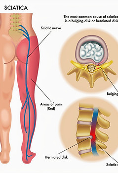 disc-nerve-pain_