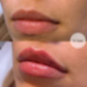 Filler labbra Lip filler