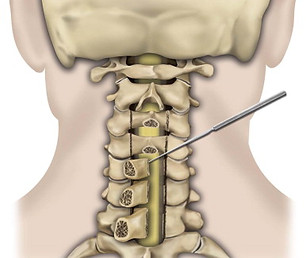 cirurgia hernia cervical chapeco.jfif