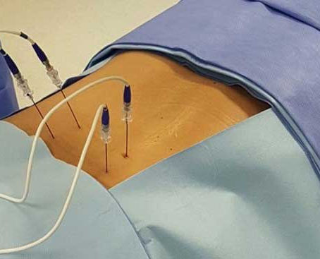 Infiltrações na Coluna: Quando Aliviar a Dor é a Melhor Escolha