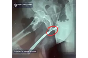 Understanding Urethral Stricture