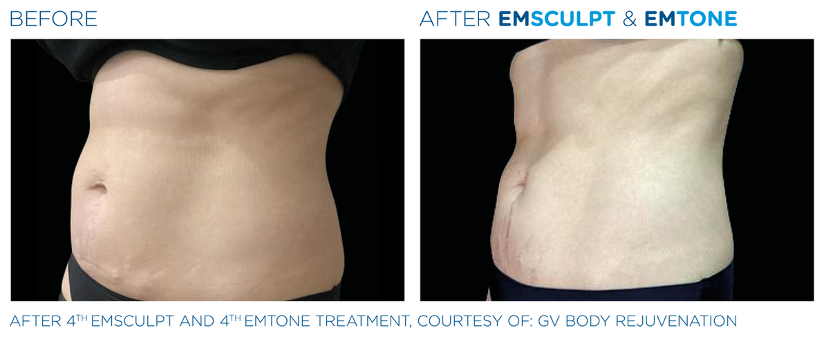 Emsculpt_Emtone_PIC_Ba-card-female-abdomen-026_ENAU100.png