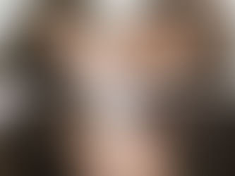 Telogen effluvium - a cause of hair loss