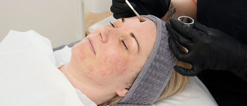 Close-up view of a chemical peel procedure