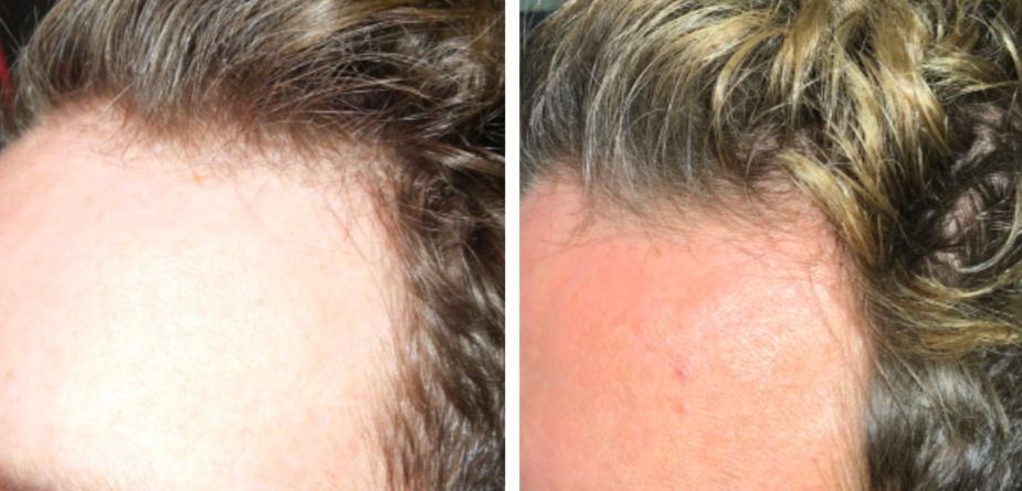 Rejuvenus Hair Restoration Exosomes.jpg