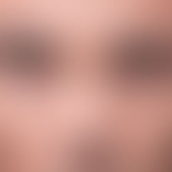 The Ultimate Guide to Undereye Fillers in Toronto for a Refreshed Look: : Say Goodbye to Tired Eyes