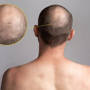 Exosomas y Sueroterapia para tratar la Caída del Cabello