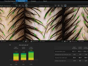 Unlocking Hair Health: Revolutionary Hair Analysis with HairMetrix at Rejuvenus Clinic