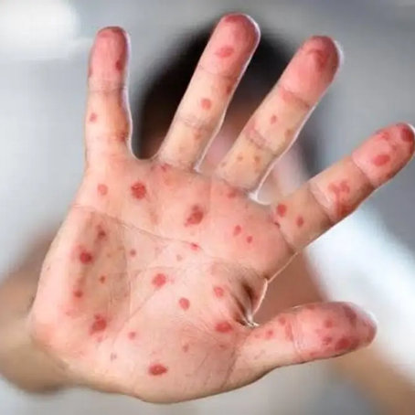 Posibles casos de sarampión en México