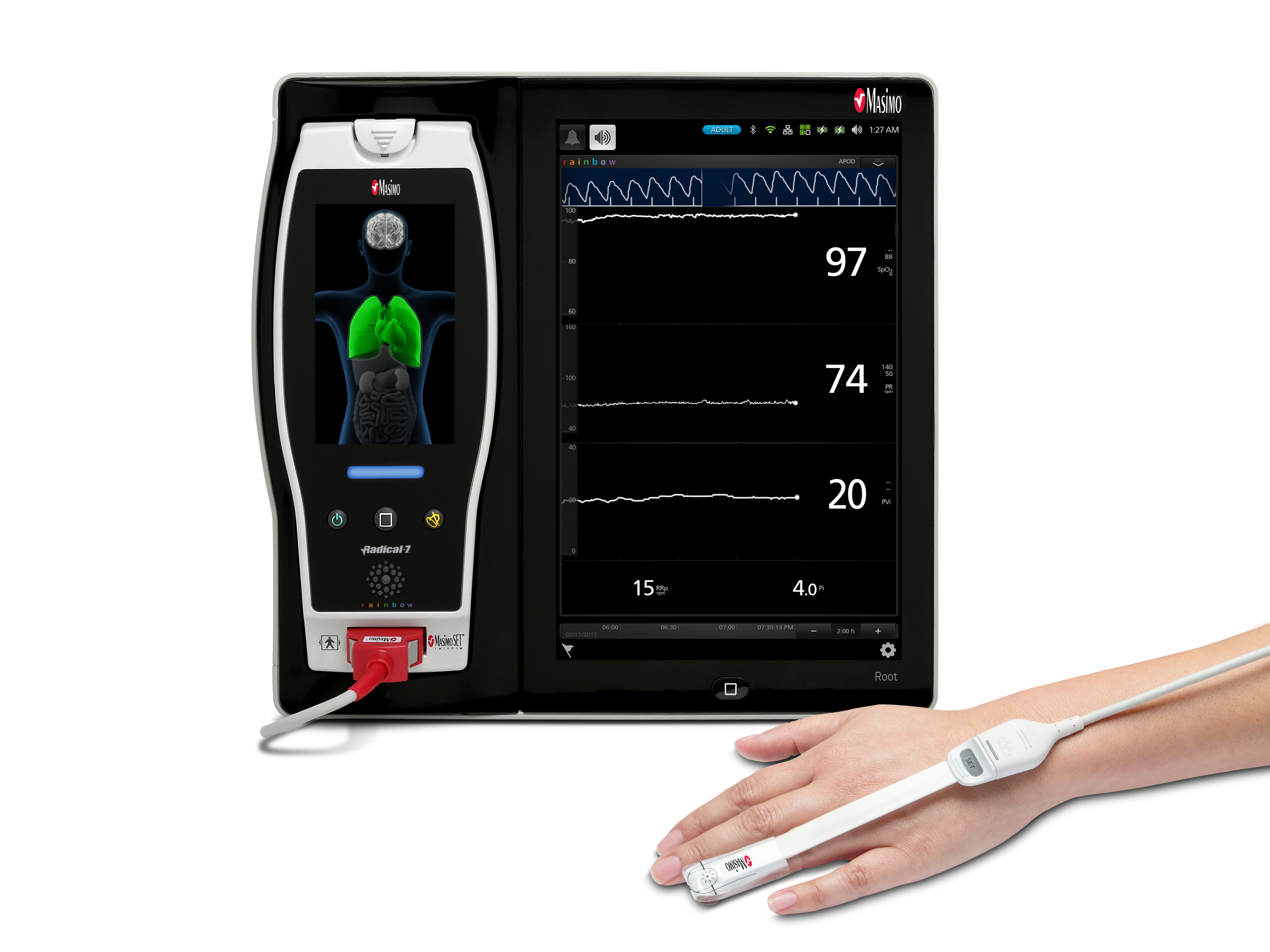 Masimo PVi®, 신경외과 대수술을 받는 아동의 체액 반응성을 안정적으로 예측