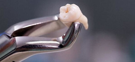 extração-siso-dentista-bh-clinica-odonto