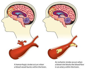 stroke