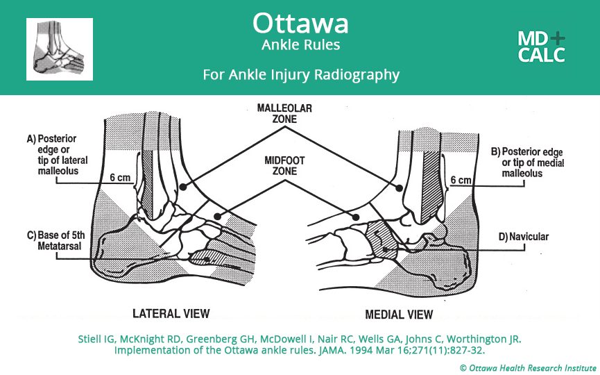 Ottawa Ankle Rules