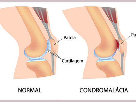 Condromalacia Patelar