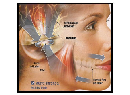Disfunção Temporo Mandibular