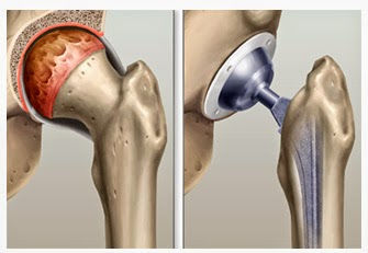 Artroplastia de Quadril