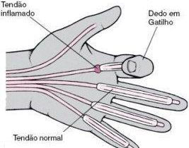 Dedo em Gatilho