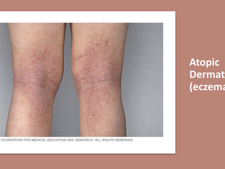 Eczema by Vice President Mehek