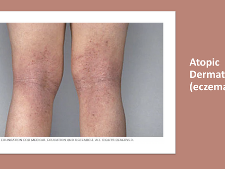 Eczema by Vice President Mehek