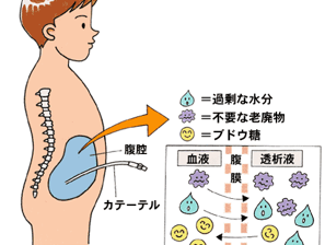 末期腎不全とその治療法(腹膜透析・血液透析・腎移植)/患者様向け医療情報