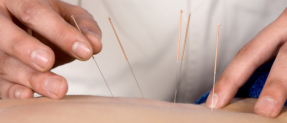 Acupuncture