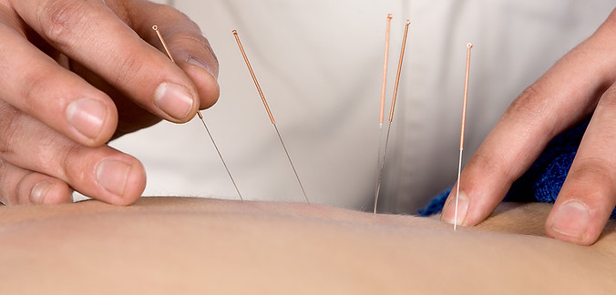 Acupuncture Therapy Session