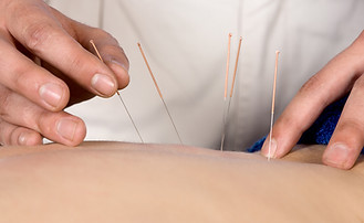 Acupuncture