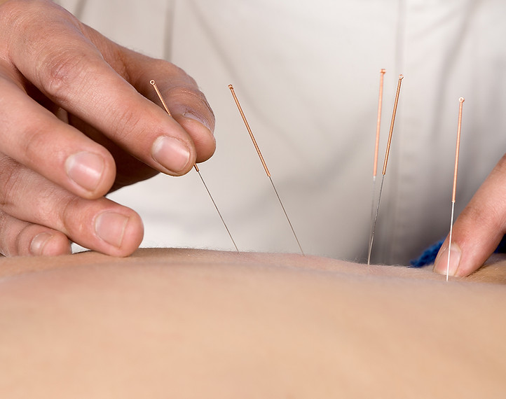 Acupuncture