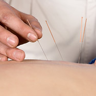 Acupuncture Therapy Session