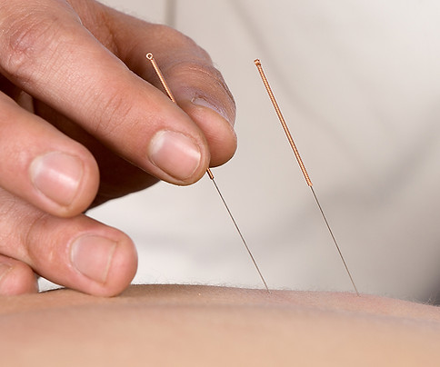 Acupuncture