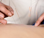 Acupuncture