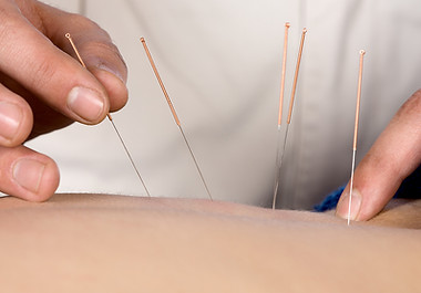 Acupuncture