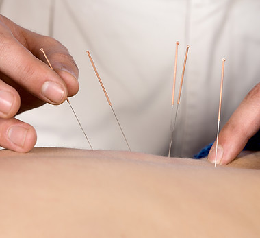 Acupuncture Therapy Session