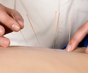 Acupuncture