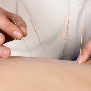 Acupuncture